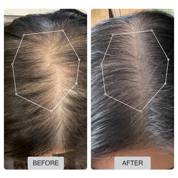 Capillus Spectrum - view 4