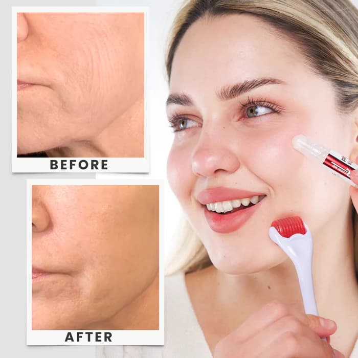 PlasmaSomes™ / Micro-Needle Kit --- 3 month supply - view 5